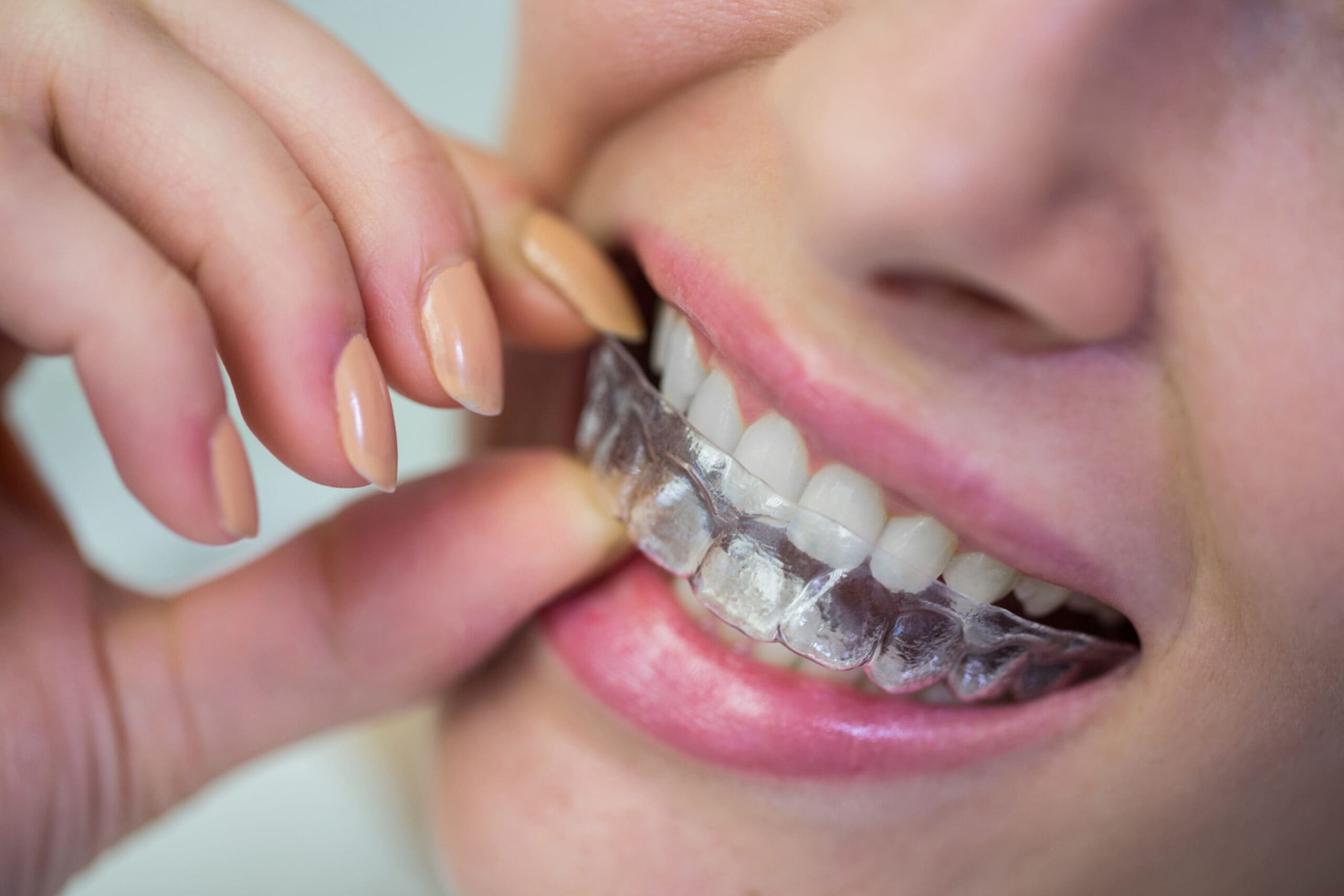 You are currently viewing Braces vs. Invisalign . Which Is Better for Adults?