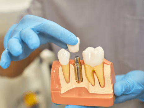 Read more about the article Dental Implants in Koramangala: Your Complete Guide to a Confident Smile