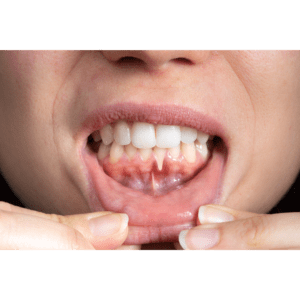 Read more about the article The Early Signs of Gum Disease You Should Never Ignore