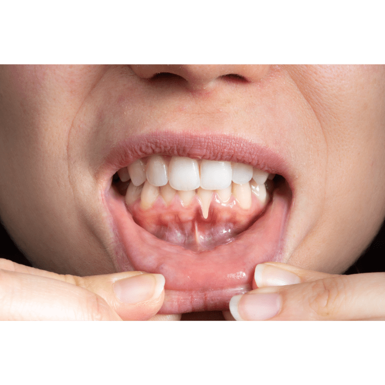 Read more about the article The Early Signs of Gum Disease You Should Never Ignore
