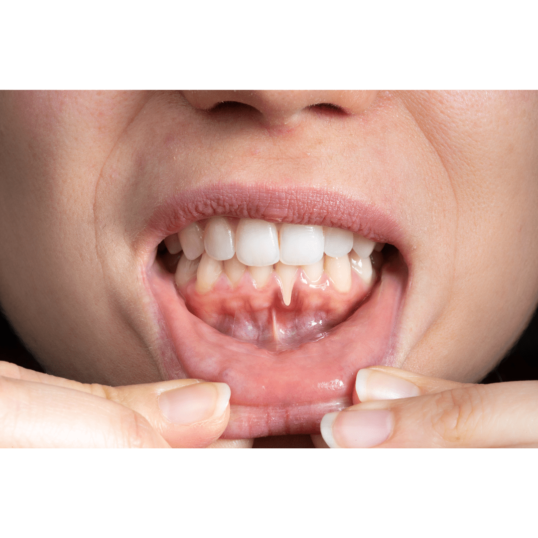 You are currently viewing The Early Signs of Gum Disease You Should Never Ignore