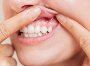 Read more about the article Bleeding Gums While Brushing? Causes, Fixes & When to See a Dentist