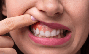 Read more about the article Why Do My Gums Feel Sore or Swollen? Common Causes Explained
