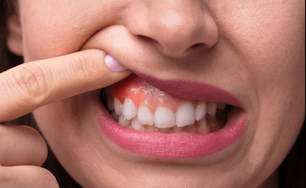 You are currently viewing Why Do My Gums Feel Sore or Swollen? Common Causes Explained