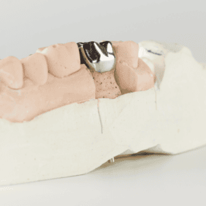 Read more about the article Dental Crowns Explained: When Do You Need One?