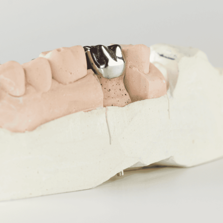 Read more about the article Dental Crowns Explained: When Do You Need One?