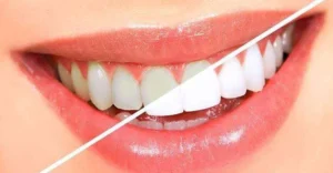 Read more about the article Are Teeth Whitening Treatments Safe? What Patients Should Know