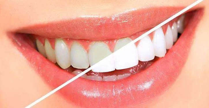 You are currently viewing Are Teeth Whitening Treatments Safe? What Patients Should Know